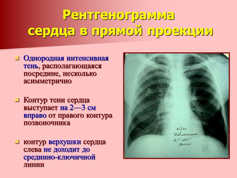 Рентгенограмма  сердца в прямой проекции Однородная интенсивная тень, располагающаяся посредине, несколько асимметрично 